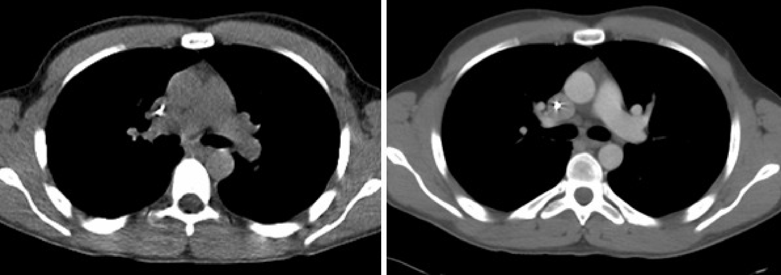 Left: CT image, acquisition with 30 mAs and no contrast. Right: CT image, acquisition with 140 mAs and intravenously injected contrast agent.