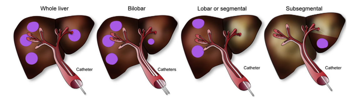Radioactive microspheres are sent into the liver through selected branches of the portal vein, targeting the tumors. .