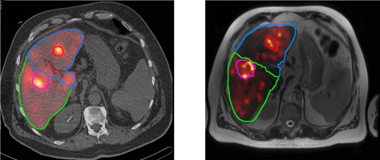 Left: the 99mTc-MAA image (in color) fused with the corresponding CT image (black and white), from the pre-treatment SPECT/CT image. Right: the ^{90}Y-PET image fused with the corresponding MR image, from the post-treatment PET/MR image.