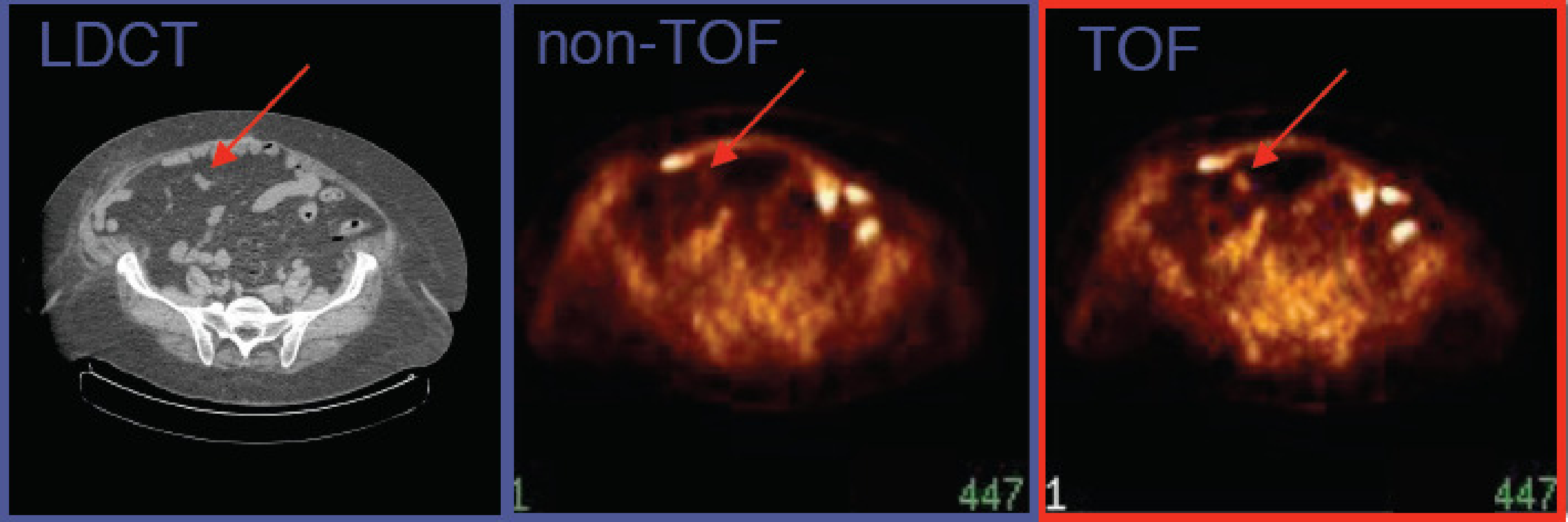 CT and TOF-PET image, acquired on a PET/CT system with time-of-flight resolution of about 700 ps. The TOF-PET image reveals a small lesion not seen on the non-TOF PET image. (Courtesy Joel Karp and Samuel Matej, University of Pennsylvania. The image is acquired on a Philips Gemini TOF-PET system)