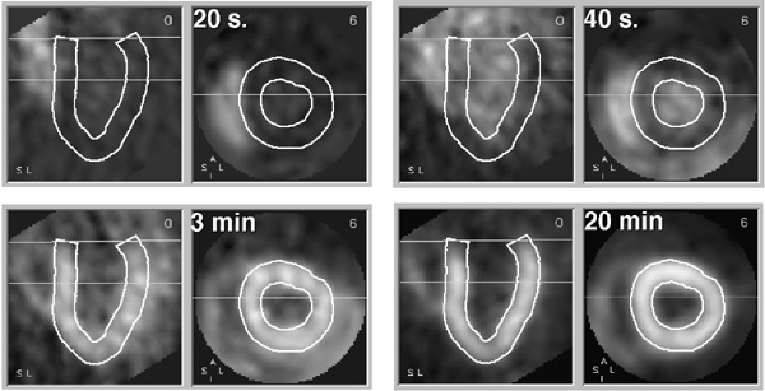 Four samples from a dynamic study. Each sample shows a short axis and long axis slice through the heart. The wall of the left ventricle is delineated. 20 s after injection, the tracer is in the right ventricle. At 40 s it arrives in the left ventricle. At 3 min, the tracer is accumulating in the ventricular wall. At 20 min, the tracer concentration in the wall is increased, resulting in better image quality.