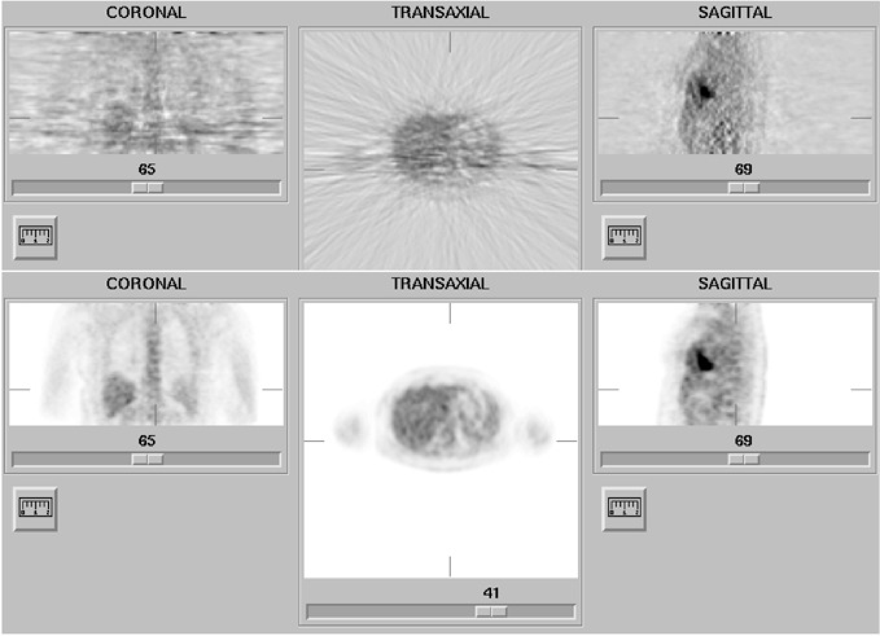 Reconstruction obtained with filtered backprojection (top) and maximum-likelihood expectation-maximization (34 iterations) (bottom). The streak artifacts in the filtered backprojection image are due to the statistical noise on the measured projection (Poisson noise).