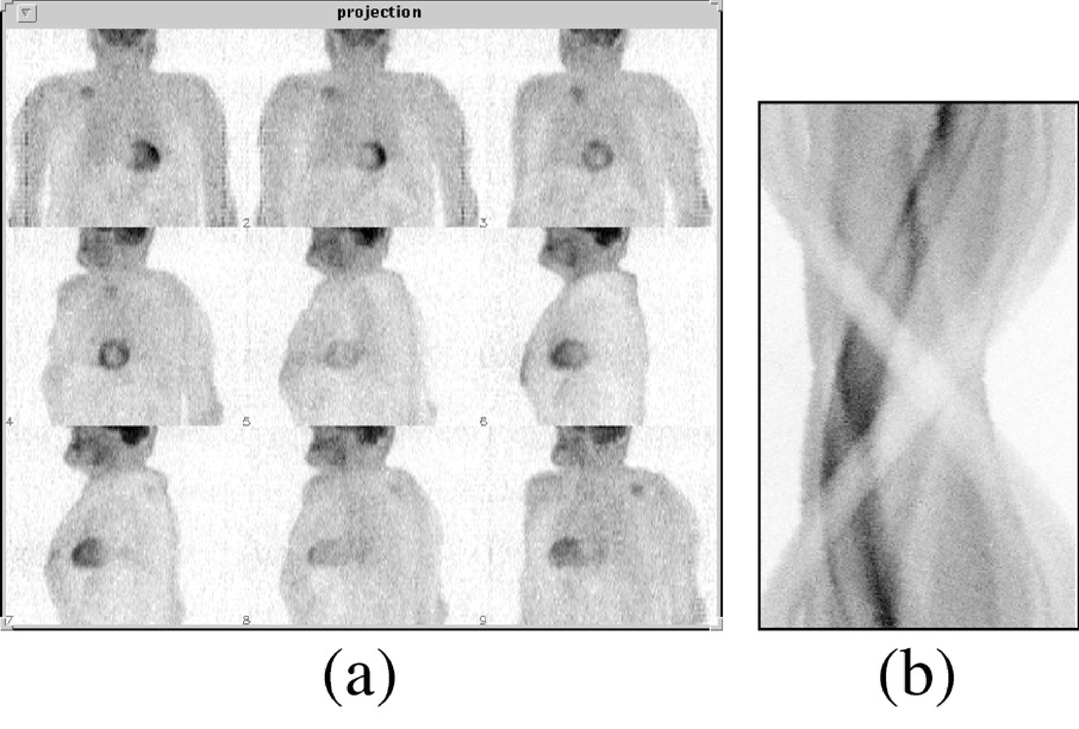 Raw PET data, organized as projections (a) or as a sinogram (b). There are typically a few hundred projections, one for each projection angle, and several tens to hundred sinograms, one for each slice through the patient body
