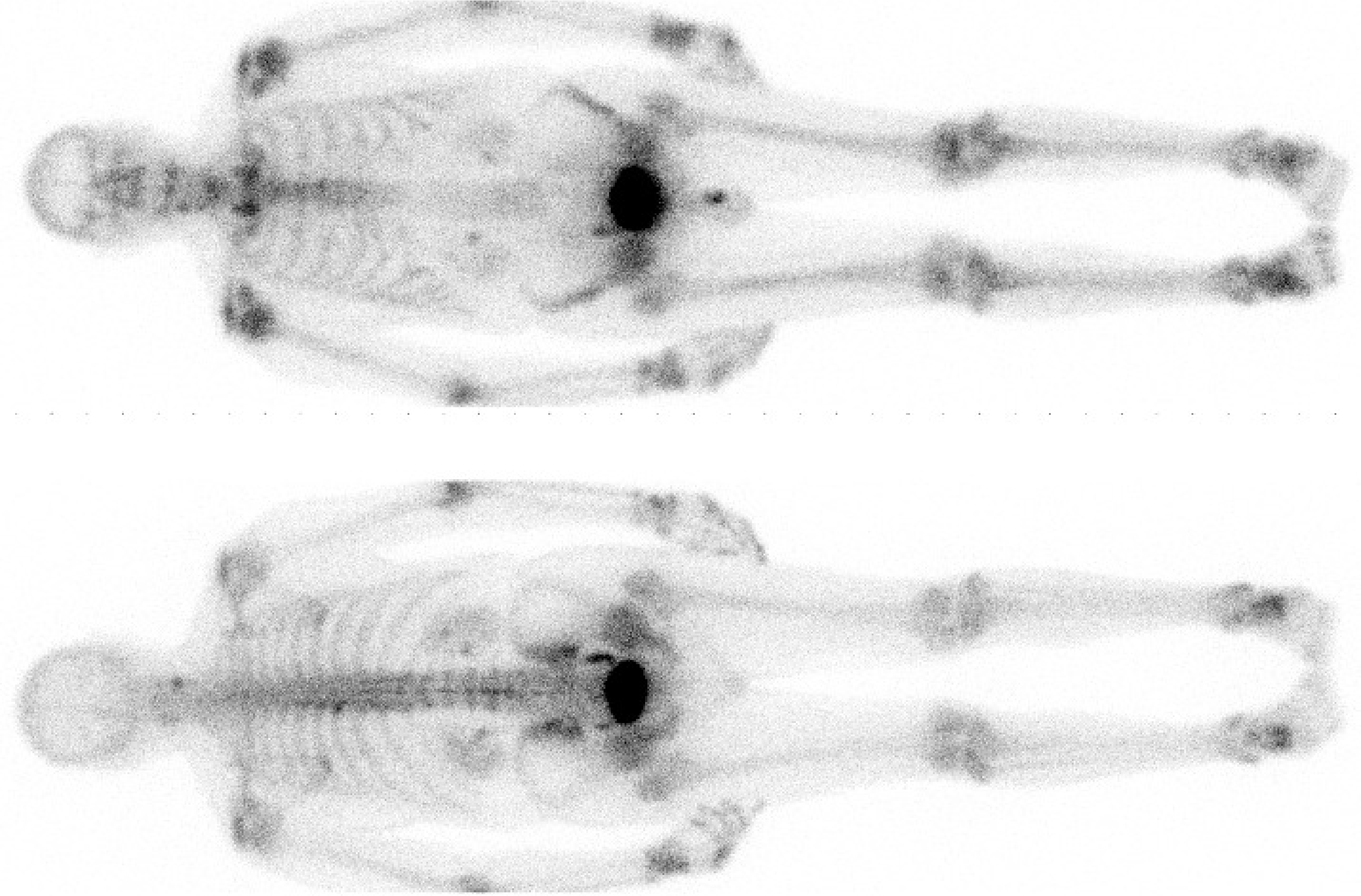 99mTc-MDP study acquired on a dual head gamma camera. Detector size is about 40 \times 50 cm, the whole body images are acquired with slow translation of the patient bed. MDP accumulates in bone, allowing visualization of increased bone metabolism. Due to attenuation, the spine is better visualized on the posterior image.