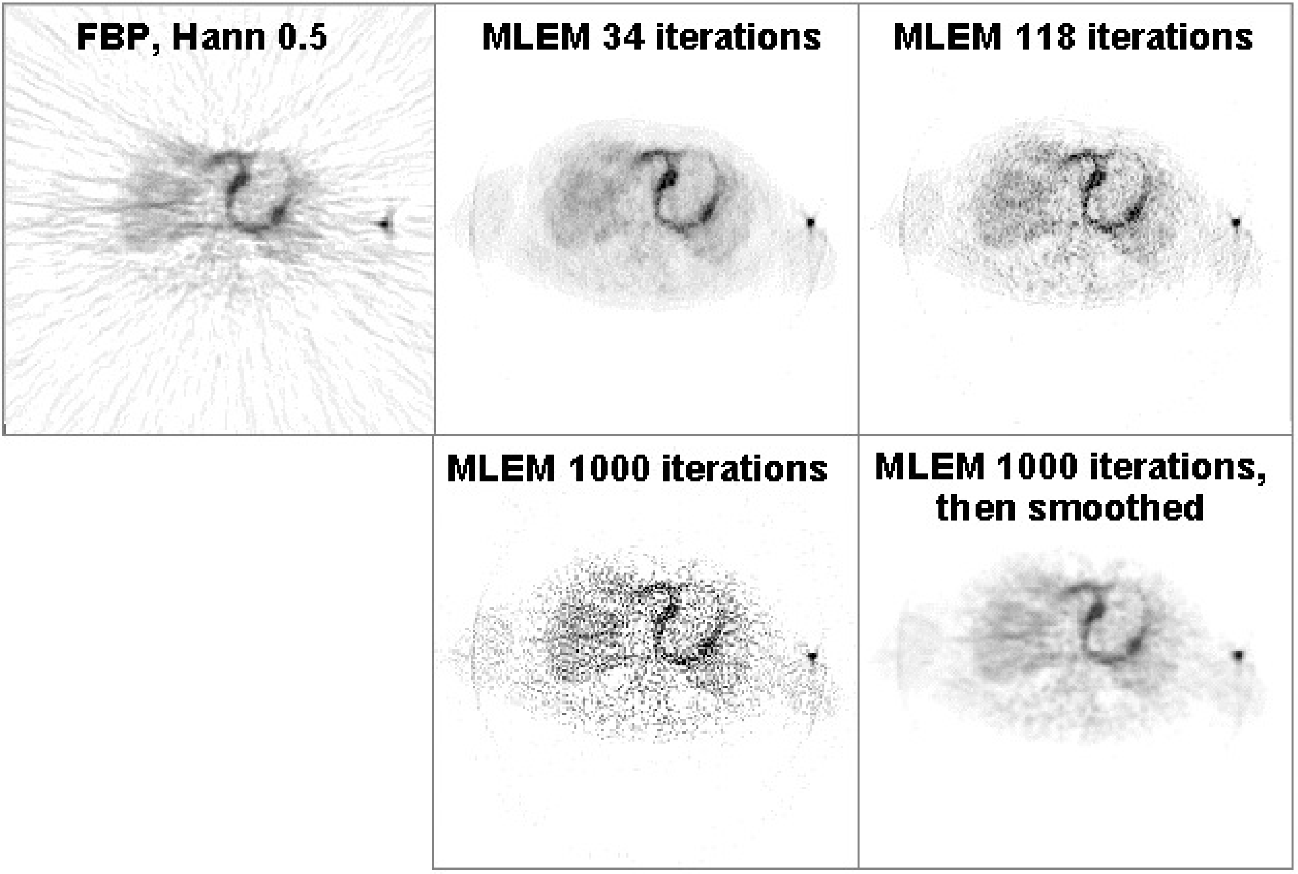 Reconstruction of a cardiac PET scan with FBP, and with MLEM. The images obtained after 34, 118 and 1000 iterations are shown. The image at 1000 iterations is very noisy, but a bit of smoothing turns it into a very useful image.