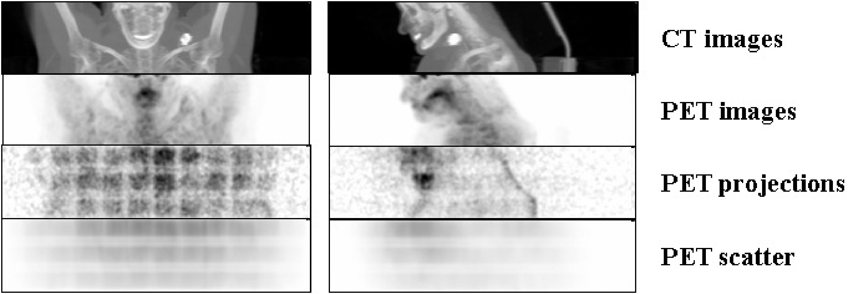 CT and PET images (obtained by maximum intensity projection), and the corresponding raw PET projection data with their estimated scatter contribution. Data were acquired with a Biograph 16 PET/CT system (Siemens). The regular pattern in the raw data is due to sensitivity differences between different detector pairs (see also fig %s).