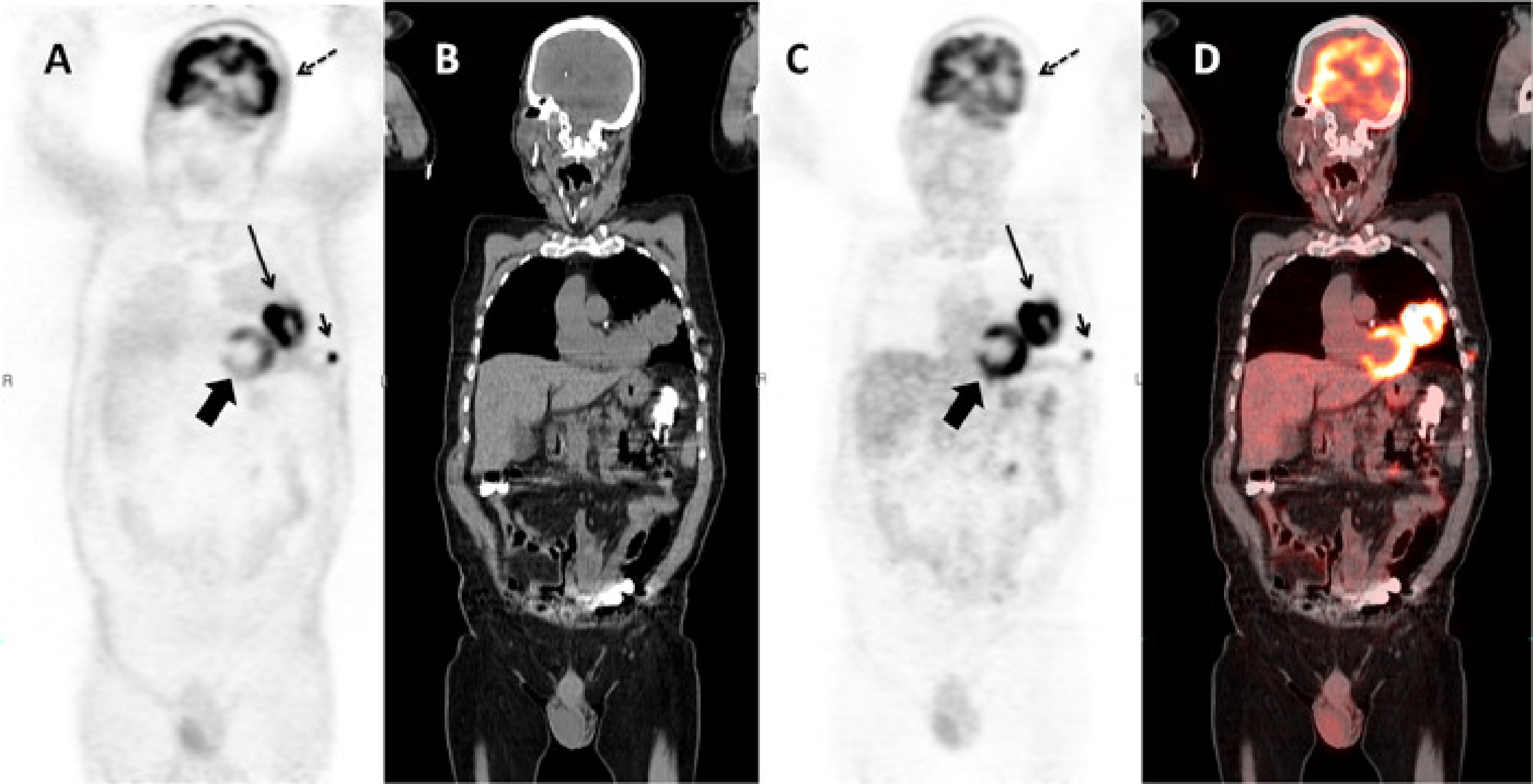 Coronal slice of a whole body PET/CT study reconstructed without (A) and with (C) attenuation correction based on a whole body CT (B). PET and CT are combined in a fusion image (D). The relative intensity of the subcutaneous metastasis (small arrow) compared to the primary tumor (large arrow) is much higher in the non corrected image than in the corrected one, because the activity in this peripheral lesion is much less attenuated than the activity in the primary tumor. A striking artifact in (A) is the apparent high uptake in the skin and the lungs. Note also that regions of homogenous uptake, such as the heart (thick arrow), are no longer homogenous, but show a gradient. The uptake in the left side of the brain (dotted arrow) is apparently lower than in the contralateral one in (C). The fusion image shows that the head did move between the acquisition of the CT and the emission data, resulting in an apparent decrease in activity in the left side of the brain due errors in the attenuation correction.
