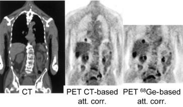PET/CT attenuation artifact due to breathing. The tumor is really located in the liver, but the mismatch with the CT and the resulting attenuation correction errors make it show up in the lung.This figure is from a paper by Sarikaya, Yeung, Erdi and Larson, Clinical Nuclear Medicine, 2003; 11: 943