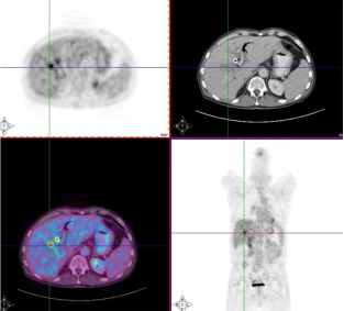Images from a PET/CT system, allowing simultaneous inspection of anatomy and function.