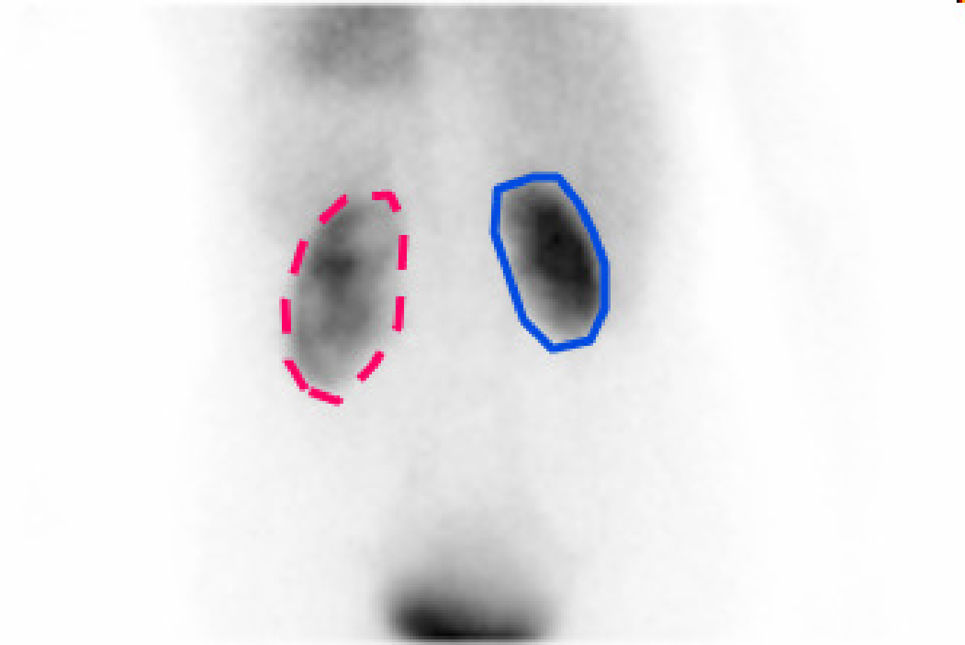 Summing all frames of the dynamic renal study yields the image on the left, where the kidneys can be easily delineated. The total count in these regions as a function of time (time activity curves or TACs) are shown on the right, revealing a distinct difference in kidney function.