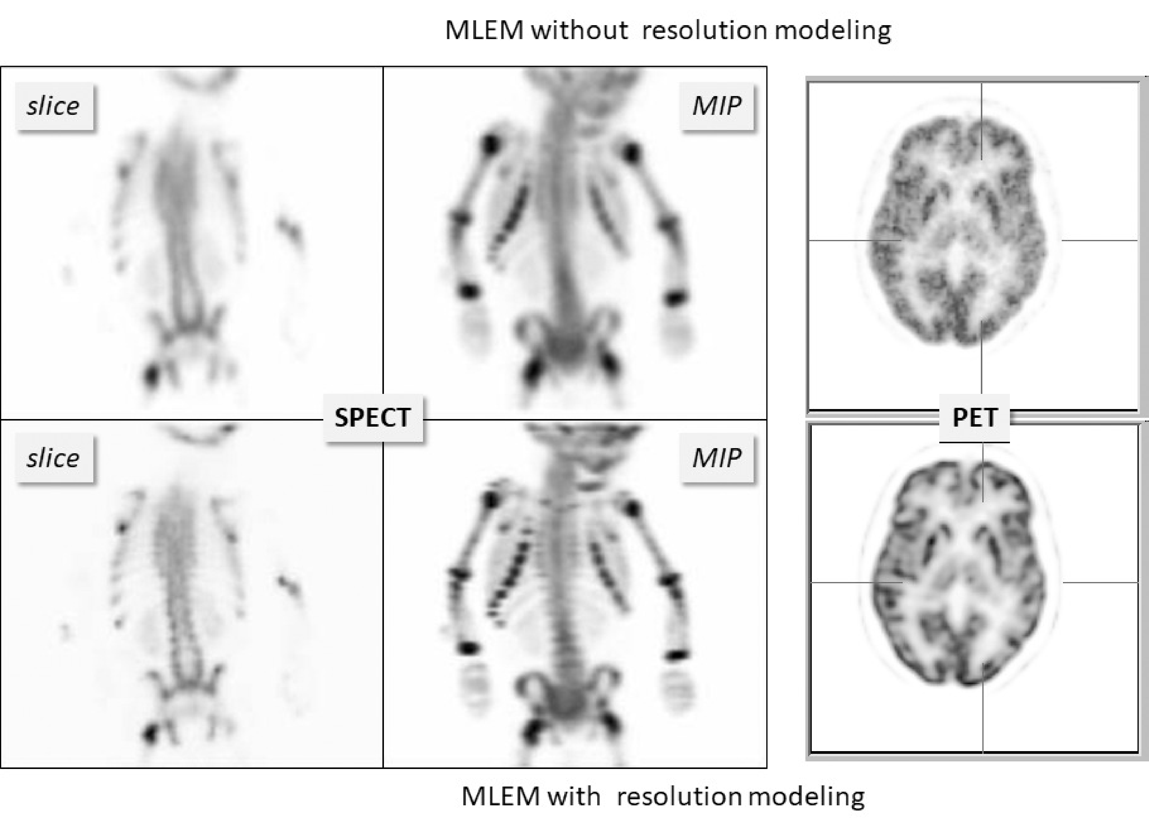Reconstructions with and without resolution modeling from a SPECT bone scan of a child and a brain PET scan. “MIP” denotes “maximum intensity projection”. MLEM with resolution modeling recovers image detail that was suppressed by the finite system resolution.
