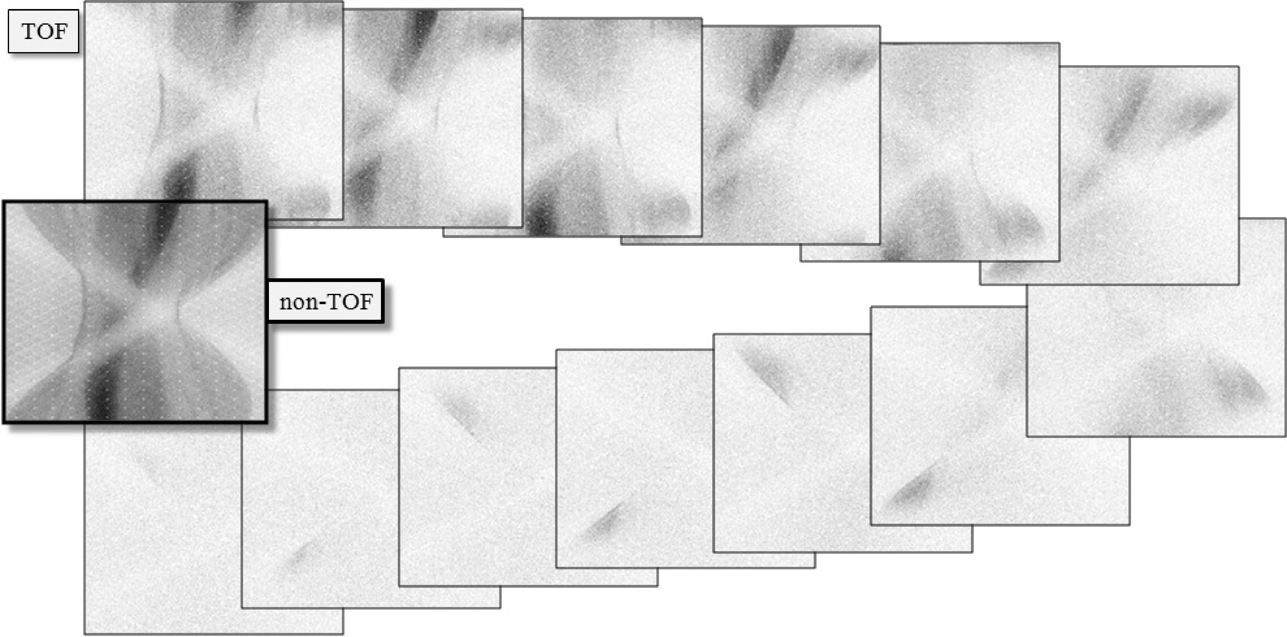 A single plane from a clinical TOF-data set, sampled at 13 TOF-bins. The first bin corresponds to the center, the subsequent bins are for increasing distances, alternatedly in both directions. The non-TOF sinogram was obtained by summing the 13 TOF-sinograms.