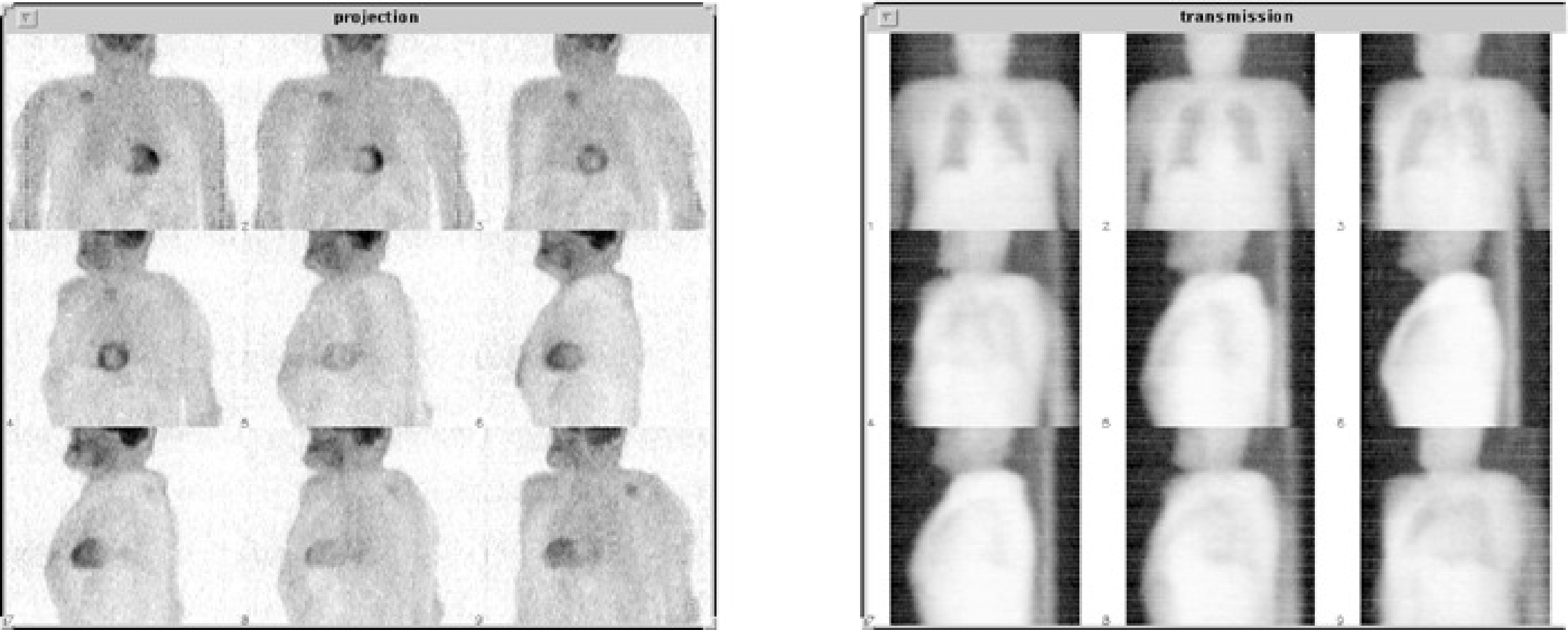 Left: emission PET projections. Right: transmission projections of the same patient.